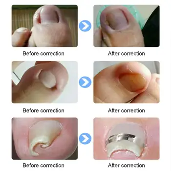 Иновативен Aid Професионални Коректори за изправяне на ноктите на краката Выпрямляющий Скоба Скоба Педикюрный инструмент за Ефективна Грижа за ноктите