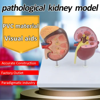 Модел на нормални и болни бъбреци Модел на отделителната система Модел анатомия на бъбреците